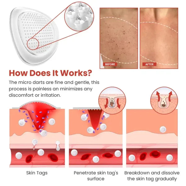Derma Smooth Skin Tag Removal Patch | BUY ONE GET ONE FREE